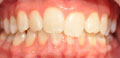 invisalign lite case