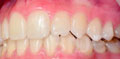 invisalign lite case