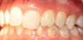 invisalign lite case