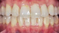 invisalign case 1
