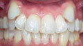 invisalign case 1