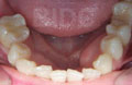 invisalign case 1