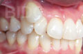 invisalign case 1