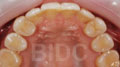 invisalign case 1