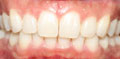 invisalign case