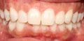 invisalign case