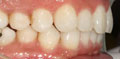 invisalign case