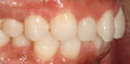 invisalign case