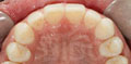invisalign case