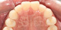 invisalign case