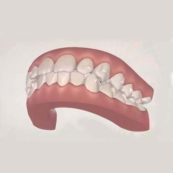 Clin check invisalign