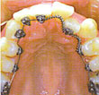 internal braces