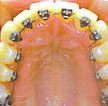 invisible lingual braces