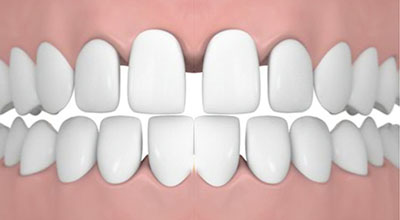Gaps in Teeth