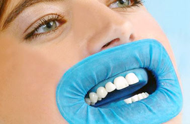 fillings removal