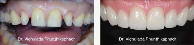 crowns dental cases