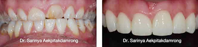 crowns dental case
