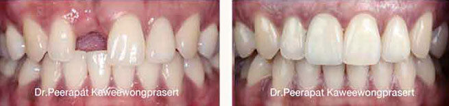 implant dental cases