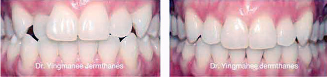 braces dental cases