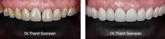 veneer dental cases