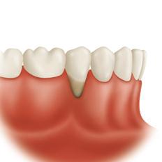 gums grafts