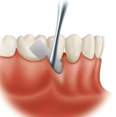 gingival graft