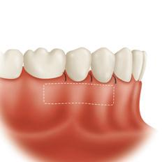 Periodontal Treatments