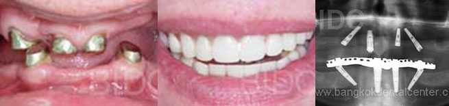 all-on-4 dental cases