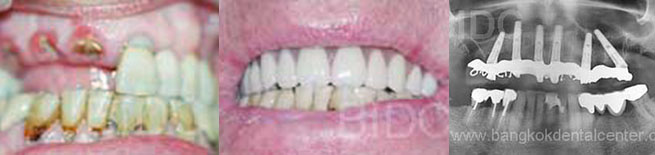 all-on-6 dental cases