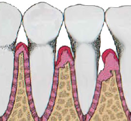 periodontitis