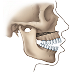 jaw surgery open bite