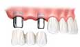 bridge dental implant fees