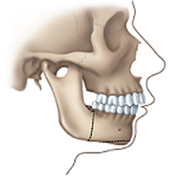 jaw surgery receding jaw