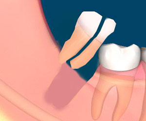 Surgical tooth extraction