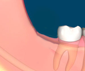 Tooth extraction