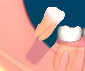 teeth extraction