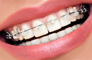 dental braces