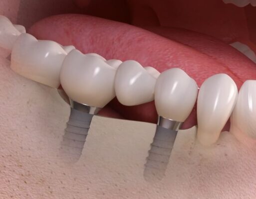 implant bridge