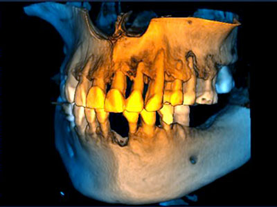 jaw surgery