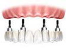 dental implant prices