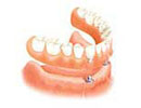 dentures dental implant fees