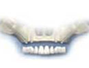 zygoma dental implant fees