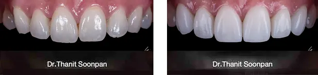 Super-thin Veneers