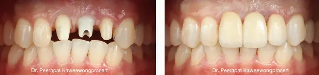 Multiple Missing Teeth